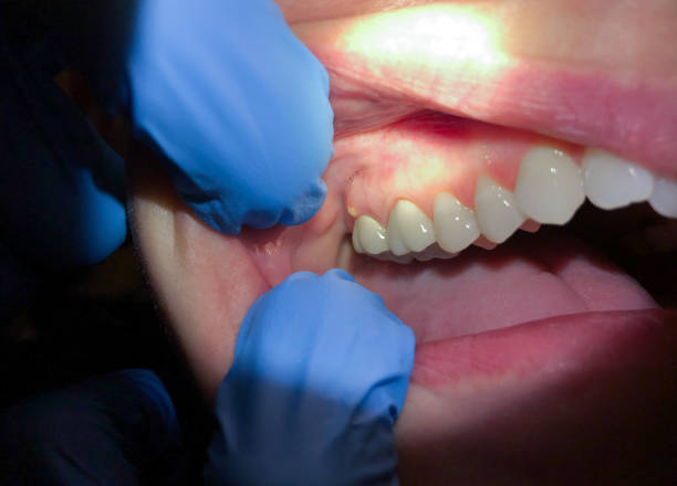 Best Knocked-Out Tooth Emergency  in Druid Hills, GA