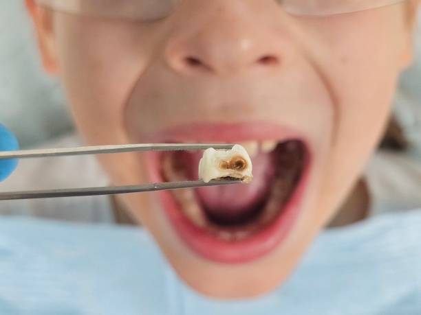Best Tooth Infection Emergency Dentist  in Druid Hills, GA